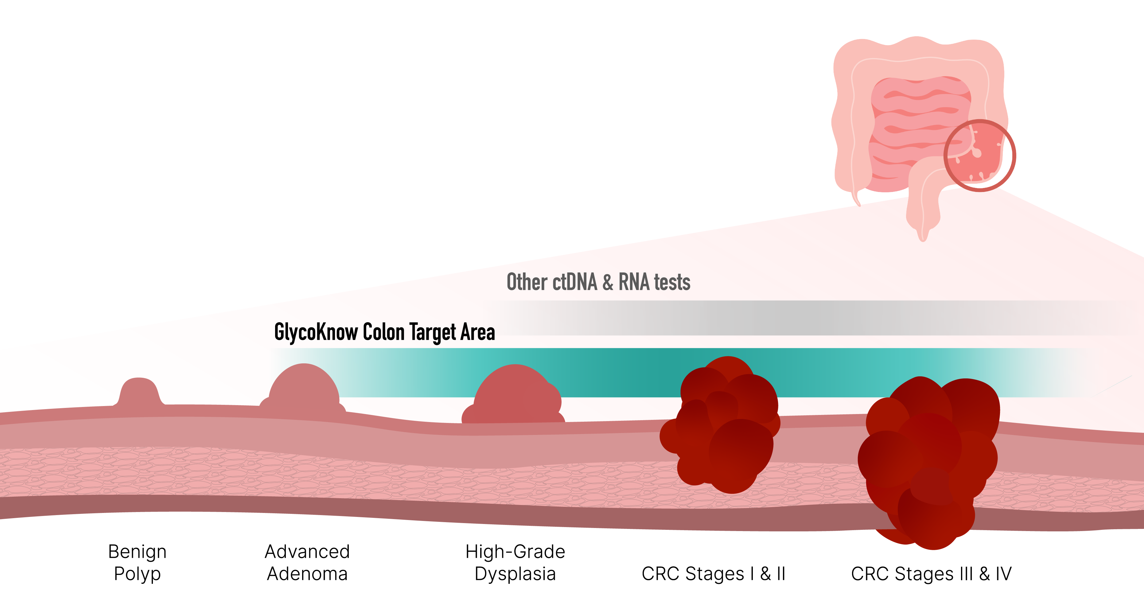 colon cancer progression with glycoknow colon target area extended from high grade dysplasia to stage 4